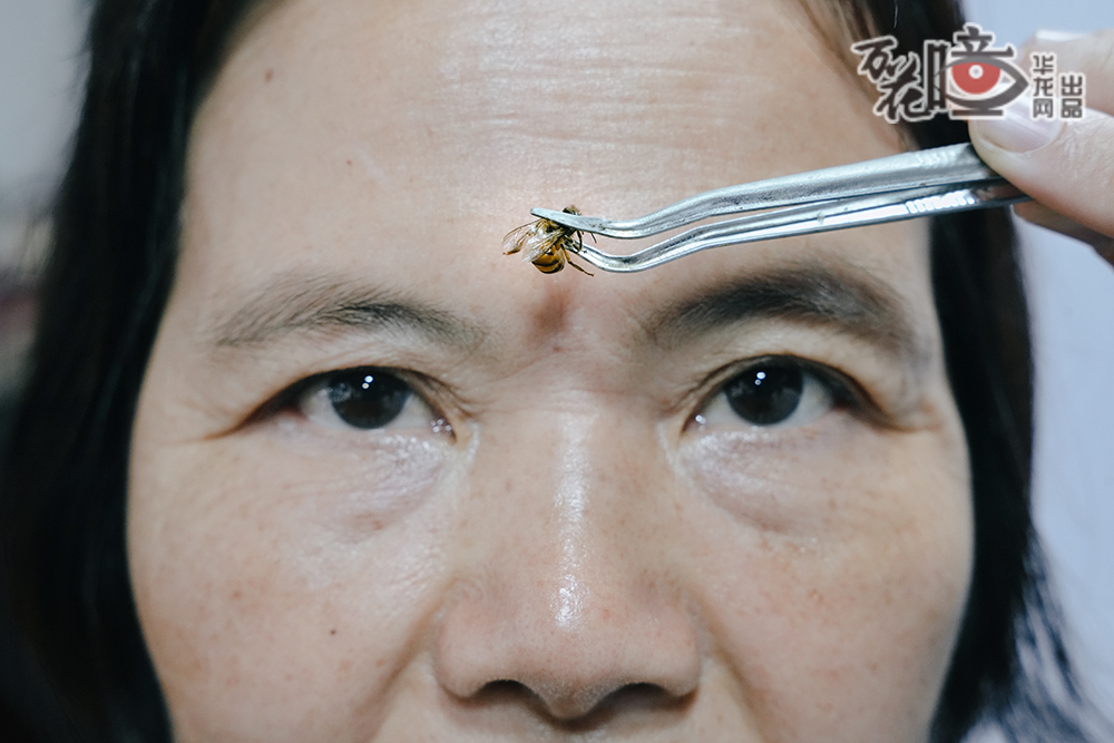 被蜜蜂蜇了竟能治??？沒(méi)錯(cuò)，這就是將蜂針液的藥理作用與針灸學(xué)原理相結(jié)合的蜂針療法。用鑷子夾住活蜂胸部，或用拇指和食指捏住其雙翅，置于穴位上，讓其螫刺，也可用鑷子將蜂針取下點(diǎn)刺或散刺相關(guān)穴位。 