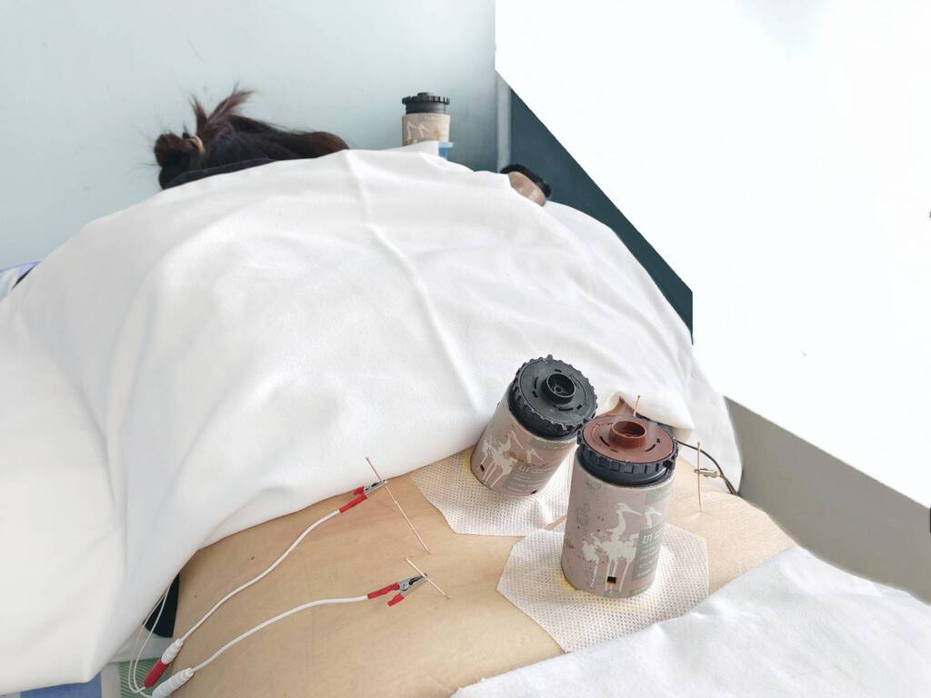 中医电针治疗疼痛